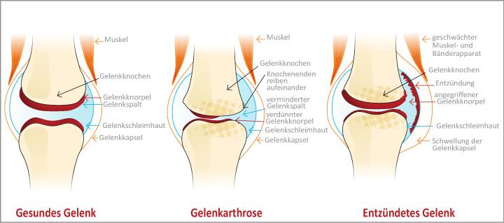 Knie Arthrose - Ursache, Symptome und Behandlung